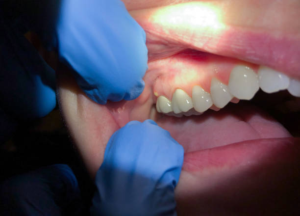 Best Emergency Treatment for Toothache in Beverly, MA